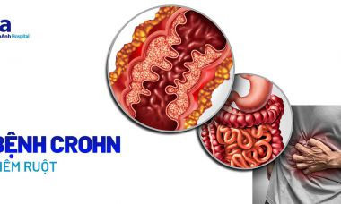 Bệnh Crohn – Tất cả những gì bạn cần biết